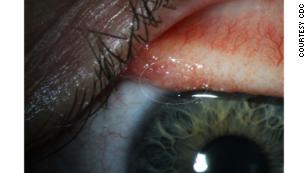 Abby Beckley&#39;s irritated eye with possible larvae.