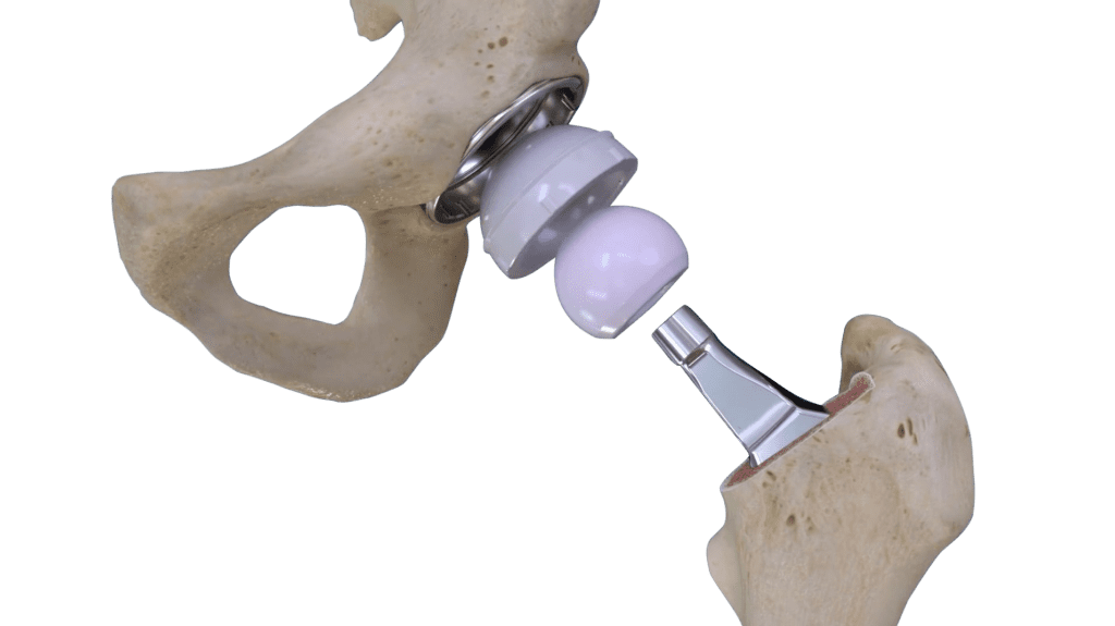a model hip with the Cordera Hip System 